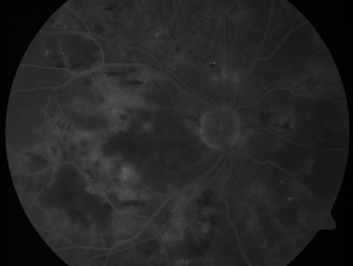 Diabetic Patient with Macular Edema and Blood Pressure 200/95
49-year-old decreasing vision over the last year. OD is 20/80, OS 20/80.   blood pressure which was 200/95.

Võtmesõnad: macular edema;cotton wool spots;diabetic;hypertensive