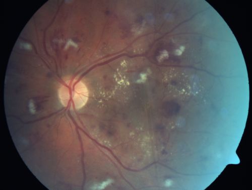 Diabetic Patient with Macular Edema and Blood Pressure 200/95
49-year-old decreasing vision over the last year. OD is 20/80, OS 20/80.   blood pressure which was 200/95.

Keywords: macular edema;cotton wool spots;diabetic;hypertensive