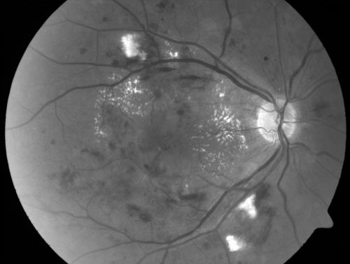 Diabetic Patient with Macular Edema and Blood Pressure 200/95
49-year-old decreasing vision over the last year. OD is 20/80, OS 20/80.   blood pressure which was 200/95.

Keywords: macular edema;cotton wool spots;diabetic;hypertensive