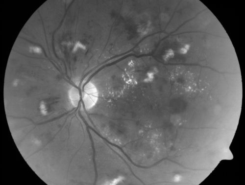 Diabetic Patient with Macular Edema and Blood Pressure 200/95
49-year-old decreasing vision over the last year. OD is 20/80, OS 20/80.   blood pressure which was 200/95.

Keywords: macular edema;cotton wool spots;diabetic;hypertensive