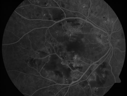 Diabetic Patient with Macular Edema and Blood Pressure 200/95
49-year-old decreasing vision over the last year. OD is 20/80, OS 20/80.   blood pressure which was 200/95.

Keywords: macular edema;cotton wool spots;diabetic;hypertensive