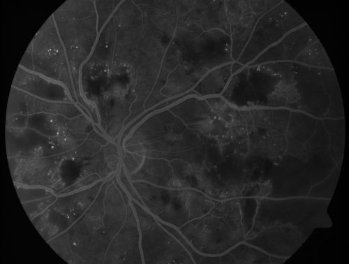 Diabetic Patient with Macular Edema and Blood Pressure 200/95
49-year-old decreasing vision over the last year. OD is 20/80, OS 20/80.   blood pressure which was 200/95.

Schlüsselwörter: macular edema;cotton wool spots;diabetic;hypertensive
