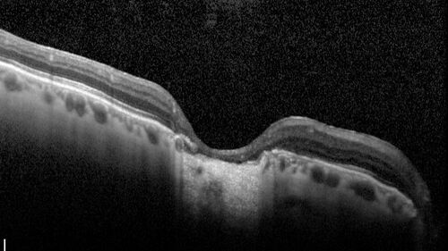 Dome Shaped Macula Left Eye
73 year old female Diagnosed with POHS in the past and treated with laser in the right eye in 1994 with vision loss.  She moved from Tampa to Largo in 2017 and started seeing Dr. Cohen.  She had her last injection in the left eye 2015 prior to moving to Largo.  She has been treated intermittently in the left eye and has been resistant to Anti-VEGF injections.  Her vision is good in the left eye. Images are from April 2023 one month following a Vabysmo injection in the left eye.
PMHx- thyroid disease
Meds: Synthroid
VA 20/200 OD, 20/25 OS
