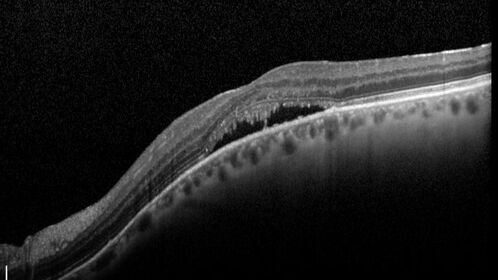 Dome Shaped Macula Left Eye
73 year old female Diagnosed with POHS in the past and treated with laser in the right eye in 1994 with vision loss.  She moved from Tampa to Largo in 2017 and started seeing Dr. Cohen.  She had her last injection in the left eye 2015 prior to moving to Largo.  She has been treated intermittently in the left eye and has been resistant to Anti-VEGF injections.  Her vision is good in the left eye. Images are from April 2023 one month following a Vabysmo injection in the left eye.
PMHx- thyroid disease
Meds: Synthroid
VA 20/200 OD, 20/25 OS
