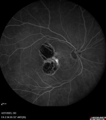 Dome Shaped Macula Left Eye
73 year old female Diagnosed with POHS in the past and treated with laser in the right eye in 1994 with vision loss.  She moved from Tampa to Largo in 2017 and started seeing Dr. Cohen.  She had her last injection in the left eye 2015 prior to moving to Largo.  She has been treated intermittently in the left eye and has been resistant to Anti-VEGF injections.  Her vision is good in the left eye. Images are from April 2023 one month following a Vabysmo injection in the left eye.
PMHx- thyroid disease
Meds: Synthroid
VA 20/200 OD, 20/25 OS
