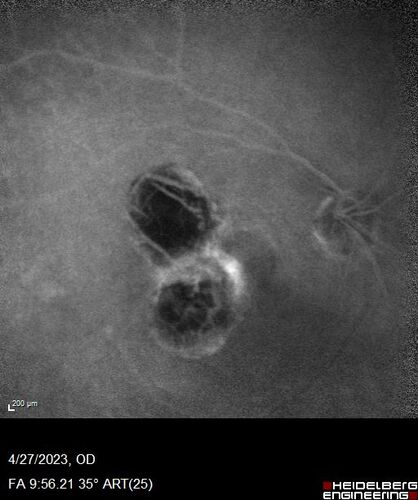 Dome Shaped Macula Left Eye
73 year old female Diagnosed with POHS in the past and treated with laser in the right eye in 1994 with vision loss.  She moved from Tampa to Largo in 2017 and started seeing Dr. Cohen.  She had her last injection in the left eye 2015 prior to moving to Largo.  She has been treated intermittently in the left eye and has been resistant to Anti-VEGF injections.  Her vision is good in the left eye. Images are from April 2023 one month following a Vabysmo injection in the left eye.
PMHx- thyroid disease
Meds: Synthroid
VA 20/200 OD, 20/25 OS
