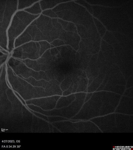 Dome Shaped Macula Left Eye
73 year old female Diagnosed with POHS in the past and treated with laser in the right eye in 1994 with vision loss.  She moved from Tampa to Largo in 2017 and started seeing Dr. Cohen.  She had her last injection in the left eye 2015 prior to moving to Largo.  She has been treated intermittently in the left eye and has been resistant to Anti-VEGF injections.  Her vision is good in the left eye. Images are from April 2023 one month following a Vabysmo injection in the left eye.
PMHx- thyroid disease
Meds: Synthroid
VA 20/200 OD, 20/25 OS
