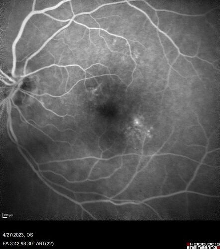 Dome Shaped Macula Left Eye
73 year old female Diagnosed with POHS in the past and treated with laser in the right eye in 1994 with vision loss.  She moved from Tampa to Largo in 2017 and started seeing Dr. Cohen.  She had her last injection in the left eye 2015 prior to moving to Largo.  She has been treated intermittently in the left eye and has been resistant to Anti-VEGF injections.  Her vision is good in the left eye. Images are from April 2023 one month following a Vabysmo injection in the left eye.
PMHx- thyroid disease
Meds: Synthroid
VA 20/200 OD, 20/25 OS
