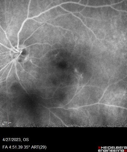 Dome Shaped Macula Left Eye
73 year old female Diagnosed with POHS in the past and treated with laser in the right eye in 1994 with vision loss.  She moved from Tampa to Largo in 2017 and started seeing Dr. Cohen.  She had her last injection in the left eye 2015 prior to moving to Largo.  She has been treated intermittently in the left eye and has been resistant to Anti-VEGF injections.  Her vision is good in the left eye. Images are from April 2023 one month following a Vabysmo injection in the left eye.
PMHx- thyroid disease
Meds: Synthroid
VA 20/200 OD, 20/25 OS
