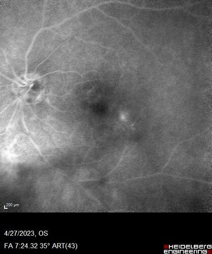 Dome Shaped Macula Left Eye
73 year old female Diagnosed with POHS in the past and treated with laser in the right eye in 1994 with vision loss.  She moved from Tampa to Largo in 2017 and started seeing Dr. Cohen.  She had her last injection in the left eye 2015 prior to moving to Largo.  She has been treated intermittently in the left eye and has been resistant to Anti-VEGF injections.  Her vision is good in the left eye. Images are from April 2023 one month following a Vabysmo injection in the left eye.
PMHx- thyroid disease
Meds: Synthroid
VA 20/200 OD, 20/25 OS
