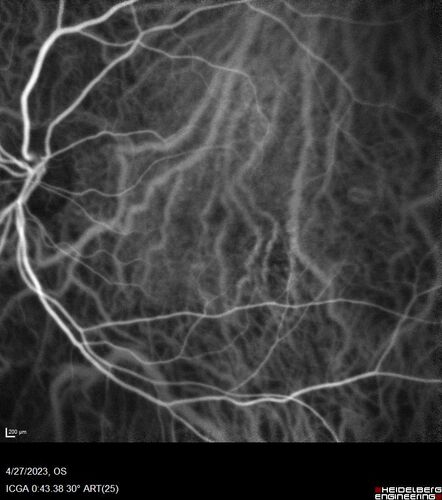 Dome Shaped Macula Left Eye
73 year old female Diagnosed with POHS in the past and treated with laser in the right eye in 1994 with vision loss.  She moved from Tampa to Largo in 2017 and started seeing Dr. Cohen.  She had her last injection in the left eye 2015 prior to moving to Largo.  She has been treated intermittently in the left eye and has been resistant to Anti-VEGF injections.  Her vision is good in the left eye. Images are from April 2023 one month following a Vabysmo injection in the left eye.
PMHx- thyroid disease
Meds: Synthroid
VA 20/200 OD, 20/25 OS
