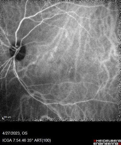 Dome Shaped Macula Left Eye
73 year old female Diagnosed with POHS in the past and treated with laser in the right eye in 1994 with vision loss.  She moved from Tampa to Largo in 2017 and started seeing Dr. Cohen.  She had her last injection in the left eye 2015 prior to moving to Largo.  She has been treated intermittently in the left eye and has been resistant to Anti-VEGF injections.  Her vision is good in the left eye. Images are from April 2023 one month following a Vabysmo injection in the left eye.
PMHx- thyroid disease
Meds: Synthroid
VA 20/200 OD, 20/25 OS

