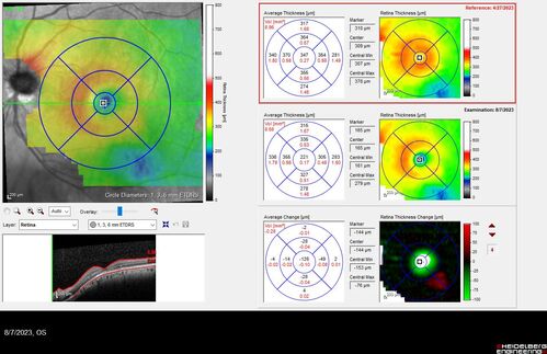 Dome Shaped Macula Left Eye
73 year old female Diagnosed with POHS in the past and treated with laser in the right eye in 1994 with vision loss.  She moved from Tampa to Largo in 2017 and started seeing Dr. Cohen.  She had her last injection in the left eye 2015 prior to moving to Largo.  She has been treated intermittently in the left eye and has been resistant to Anti-VEGF injections.  Her vision is good in the left eye. Images are from April 2023 one month following a Vabysmo injection in the left eye.
PMHx- thyroid disease
Meds: Synthroid
VA 20/200 OD, 20/25 OS
