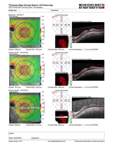 Dome Shaped Macula Left Eye
73 year old female Diagnosed with POHS in the past and treated with laser in the right eye in 1994 with vision loss.  She moved from Tampa to Largo in 2017 and started seeing Dr. Cohen.  She had her last injection in the left eye 2015 prior to moving to Largo.  She has been treated intermittently in the left eye and has been resistant to Anti-VEGF injections.  Her vision is good in the left eye. Images are from April 2023 one month following a Vabysmo injection in the left eye.
PMHx- thyroid disease
Meds: Synthroid
VA 20/200 OD, 20/25 OS

