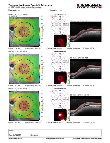 Dome Shaped Macula Left Eye
73 year old female Diagnosed with POHS in the past and treated with laser in the right eye in 1994 with vision loss.  She moved from Tampa to Largo in 2017 and started seeing Dr. Cohen.  She had her last injection in the left eye 2015 prior to moving to Largo.  She has been treated intermittently in the left eye and has been resistant to Anti-VEGF injections.  Her vision is good in the left eye. Images are from April 2023 one month following a Vabysmo injection in the left eye.
PMHx- thyroid disease
Meds: Synthroid
VA 20/200 OD, 20/25 OS
