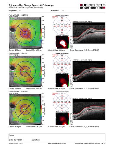 Dome Shaped Macula Left Eye
73 year old female Diagnosed with POHS in the past and treated with laser in the right eye in 1994 with vision loss.  She moved from Tampa to Largo in 2017 and started seeing Dr. Cohen.  She had her last injection in the left eye 2015 prior to moving to Largo.  She has been treated intermittently in the left eye and has been resistant to Anti-VEGF injections.  Her vision is good in the left eye. Images are from April 2023 one month following a Vabysmo injection in the left eye.
PMHx- thyroid disease
Meds: Synthroid
VA 20/200 OD, 20/25 OS
