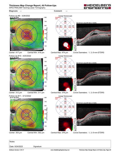 Dome Shaped Macula Left Eye
73 year old female Diagnosed with POHS in the past and treated with laser in the right eye in 1994 with vision loss.  She moved from Tampa to Largo in 2017 and started seeing Dr. Cohen.  She had her last injection in the left eye 2015 prior to moving to Largo.  She has been treated intermittently in the left eye and has been resistant to Anti-VEGF injections.  Her vision is good in the left eye. Images are from April 2023 one month following a Vabysmo injection in the left eye.
PMHx- thyroid disease
Meds: Synthroid
VA 20/200 OD, 20/25 OS
