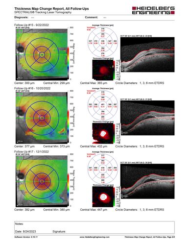 Dome Shaped Macula Left Eye
73 year old female Diagnosed with POHS in the past and treated with laser in the right eye in 1994 with vision loss.  She moved from Tampa to Largo in 2017 and started seeing Dr. Cohen.  She had her last injection in the left eye 2015 prior to moving to Largo.  She has been treated intermittently in the left eye and has been resistant to Anti-VEGF injections.  Her vision is good in the left eye. Images are from April 2023 one month following a Vabysmo injection in the left eye.
PMHx- thyroid disease
Meds: Synthroid
VA 20/200 OD, 20/25 OS
