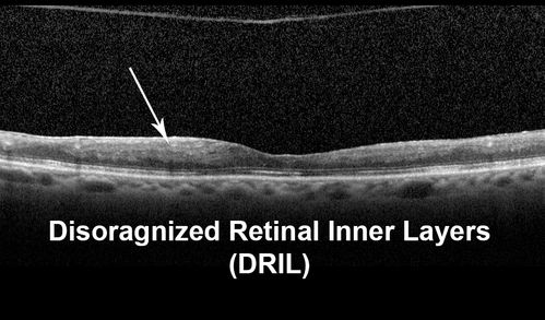 Disorganized Retinal Inner Layers (DRIL)
72 year old man treated with Avastin for CRVO VA is still 20/200 with absent macular edema (Only 1 month post rx)
