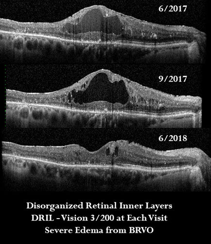 DRIL - Disorganization Retinal Inner Layers
Following treatment for BRVO vision stayed at 3/200 despite resolution of edema

