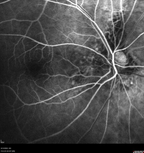 Optic nerve (disc) drusen and choroidal neovascular membrane
85 year old man - The left eye has had poor vision for 7-8 years.Â  The right eye is OK.Â  He was in for a checkup and his ophthalmologist noticed a problem and asked him to see retina doctor.Â Â 
Medical Hx: Cancer. 
Surgical Hx: Back Surgery. Gallbladder. Appendectomy. Colon Cancer.
Systemic Meds: Propafenone Hydrochloride, 225 mg oral tablet. Rosuvastatin. PAROXETINE HCL. GABAPENTIN. DONEPEZIL. Asp
VA OD: Dcc20/25-2 OS: DccCF 1ft 
IOP: TP: OD:13 OS:12
Patient's right eye was treated with Avastin and was dry with one shot.
