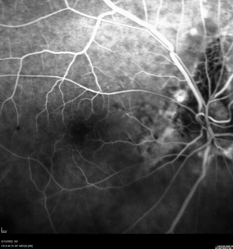 Optic nerve (disc) drusen and choroidal neovascular membrane
85 year old man - The left eye has had poor vision for 7-8 years.Â  The right eye is OK.Â  He was in for a checkup and his ophthalmologist noticed a problem and asked him to see retina doctor.Â Â 
Medical Hx: Cancer. 
Surgical Hx: Back Surgery. Gallbladder. Appendectomy. Colon Cancer.
Systemic Meds: Propafenone Hydrochloride, 225 mg oral tablet. Rosuvastatin. PAROXETINE HCL. GABAPENTIN. DONEPEZIL. Asp
VA OD: Dcc20/25-2 OS: DccCF 1ft 
IOP: TP: OD:13 OS:12
Patient's right eye was treated with Avastin and was dry with one shot.
