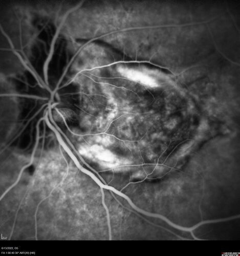 Optic nerve (disc) drusen and choroidal neovascular membrane
85 year old man - The left eye has had poor vision for 7-8 years.Â  The right eye is OK.Â  He was in for a checkup and his ophthalmologist noticed a problem and asked him to see retina doctor.Â Â 
Medical Hx: Cancer. 
Surgical Hx: Back Surgery. Gallbladder. Appendectomy. Colon Cancer.
Systemic Meds: Propafenone Hydrochloride, 225 mg oral tablet. Rosuvastatin. PAROXETINE HCL. GABAPENTIN. DONEPEZIL. Asp
VA OD: Dcc20/25-2 OS: DccCF 1ft 
IOP: TP: OD:13 OS:12
Patient's right eye was treated with Avastin and was dry with one shot.
