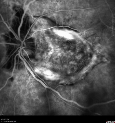 Optic nerve (disc) drusen and choroidal neovascular membrane
85 year old man - The left eye has had poor vision for 7-8 years.Â  The right eye is OK.Â  He was in for a checkup and his ophthalmologist noticed a problem and asked him to see retina doctor.Â Â 
Medical Hx: Cancer. 
Surgical Hx: Back Surgery. Gallbladder. Appendectomy. Colon Cancer.
Systemic Meds: Propafenone Hydrochloride, 225 mg oral tablet. Rosuvastatin. PAROXETINE HCL. GABAPENTIN. DONEPEZIL. Asp
VA OD: Dcc20/25-2 OS: DccCF 1ft 
IOP: TP: OD:13 OS:12
Patient's right eye was treated with Avastin and was dry with one shot.
