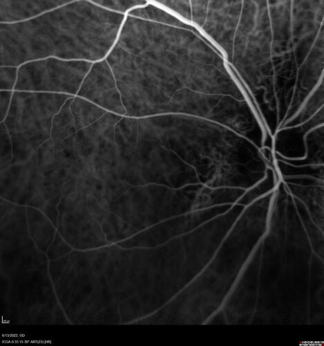 Optic nerve (disc) drusen and choroidal neovascular membrane
85 year old man - The left eye has had poor vision for 7-8 years.Â  The right eye is OK.Â  He was in for a checkup and his ophthalmologist noticed a problem and asked him to see retina doctor.Â Â 
Medical Hx: Cancer. 
Surgical Hx: Back Surgery. Gallbladder. Appendectomy. Colon Cancer.
Systemic Meds: Propafenone Hydrochloride, 225 mg oral tablet. Rosuvastatin. PAROXETINE HCL. GABAPENTIN. DONEPEZIL. Asp
VA OD: Dcc20/25-2 OS: DccCF 1ft 
IOP: TP: OD:13 OS:12
Patient's right eye was treated with Avastin and was dry with one shot.
