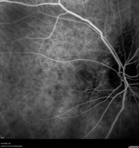 Optic nerve (disc) drusen and choroidal neovascular membrane
85 year old man - The left eye has had poor vision for 7-8 years.Â  The right eye is OK.Â  He was in for a checkup and his ophthalmologist noticed a problem and asked him to see retina doctor.Â Â 
Medical Hx: Cancer. 
Surgical Hx: Back Surgery. Gallbladder. Appendectomy. Colon Cancer.
Systemic Meds: Propafenone Hydrochloride, 225 mg oral tablet. Rosuvastatin. PAROXETINE HCL. GABAPENTIN. DONEPEZIL. Asp
VA OD: Dcc20/25-2 OS: DccCF 1ft 
IOP: TP: OD:13 OS:12
Patient's right eye was treated with Avastin and was dry with one shot.
