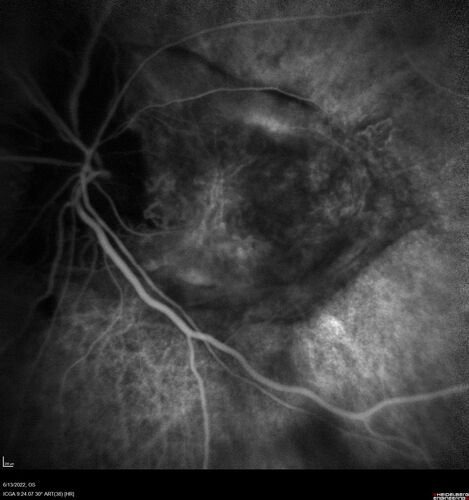 Optic nerve (disc) drusen and choroidal neovascular membrane
85 year old man - The left eye has had poor vision for 7-8 years.Â  The right eye is OK.Â  He was in for a checkup and his ophthalmologist noticed a problem and asked him to see retina doctor.Â Â 
Medical Hx: Cancer. 
Surgical Hx: Back Surgery. Gallbladder. Appendectomy. Colon Cancer.
Systemic Meds: Propafenone Hydrochloride, 225 mg oral tablet. Rosuvastatin. PAROXETINE HCL. GABAPENTIN. DONEPEZIL. Asp
VA OD: Dcc20/25-2 OS: DccCF 1ft 
IOP: TP: OD:13 OS:12
Patient's right eye was treated with Avastin and was dry with one shot.
