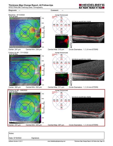 Optic nerve (disc) drusen and choroidal neovascular membrane
85 year old man - The left eye has had poor vision for 7-8 years.Â  The right eye is OK.Â  He was in for a checkup and his ophthalmologist noticed a problem and asked him to see retina doctor.Â Â 
Medical Hx: Cancer. 
Surgical Hx: Back Surgery. Gallbladder. Appendectomy. Colon Cancer.
Systemic Meds: Propafenone Hydrochloride, 225 mg oral tablet. Rosuvastatin. PAROXETINE HCL. GABAPENTIN. DONEPEZIL. Asp
VA OD: Dcc20/25-2 OS: DccCF 1ft 
IOP: TP: OD:13 OS:12
Patient's right eye was treated with Avastin and was dry with one shot.
