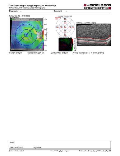 Optic nerve (disc) drusen and choroidal neovascular membrane
85 year old man - The left eye has had poor vision for 7-8 years.Â  The right eye is OK.Â  He was in for a checkup and his ophthalmologist noticed a problem and asked him to see retina doctor.Â Â 
Medical Hx: Cancer. 
Surgical Hx: Back Surgery. Gallbladder. Appendectomy. Colon Cancer.
Systemic Meds: Propafenone Hydrochloride, 225 mg oral tablet. Rosuvastatin. PAROXETINE HCL. GABAPENTIN. DONEPEZIL. Asp
VA OD: Dcc20/25-2 OS: DccCF 1ft 
IOP: TP: OD:13 OS:12
Patient's right eye was treated with Avastin and was dry with one shot.
