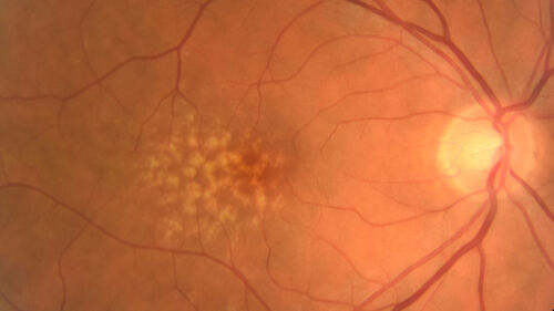 Large and Extensive Macular Drusen
64 year old female with 20/25 vision taking vitamins in for a checkup.
