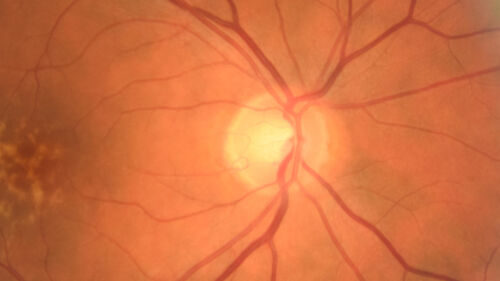 Large and Extensive Macular Drusen
64 year old female with 20/25 vision taking vitamins in for a checkup.
