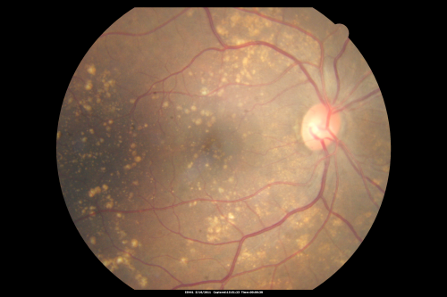 Drusen Maculopathy - Macular Degeneration (Dry) - 50 year old African-American Woman
50-year-old woman has drusen and maculopathy.  VISUAL ACUITY:  OD 20/30,  OS 20/25.  

