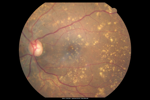 Drusen Maculopathy - Macular Degeneration (Dry) - 50 year old African-American Woman
50-year-old woman has drusen and maculopathy.  VISUAL ACUITY:  OD 20/30,  OS 20/25.  
