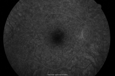Basal Laminar Drusen - Cuticular Drusen - 19 Year Old with Lupus Nephritis
19-year-old.  She has a history of developing severe systemic lupus erythematosus in 2001.  She was in renal failure and had biopsy proven Class 2 lupus nephritis.  She is currently on Plaquenil 400 mg for six years, as well as Prednisolone orally, every other day. OD 20/20, OS 20/25.
Schlüsselwörter: Basal Laminar Drusen;Cuticular Drusen