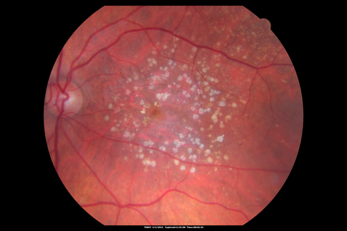 Calcified Macular Drusen - Age Related Macular Degeneration - Dry
74-year-old woman
  OD 20/25,  OS 20/32
