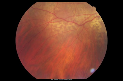 Equatorial Drusen Fundus Photo Right Eye
