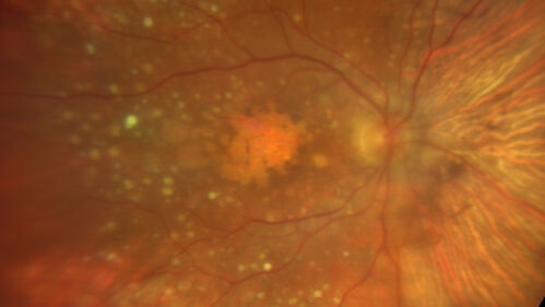Dry AMD geographic atrophy and cystoid macular edema
79 year old vision is in for a checkup with no visual complaints in the left eye.  This is her better eye.  VA 20/200 OD, 20/50 OS.  3 years ago she had a CRVO in the left eye.  She is also diabetic for 20 years, has carotid insufficiency and anemia.  Left eye shows CME.  This was not treated and the vision improved to 20/40 over the next year although mild edema persisted.
