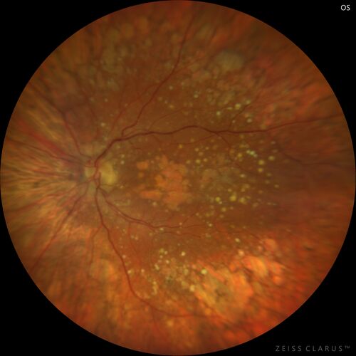 Dry AMD geographic atrophy and cystoid macular edema
79 year old vision is in for a checkup with no visual complaints in the left eye.  This is her better eye.  VA 20/200 OD, 20/50 OS.  3 years ago she had a CRVO in the left eye.  She is also diabetic for 20 years, has carotid insufficiency and anemia.  Left eye shows CME.  This was not treated and the vision improved to 20/40 over the next year although mild edema persisted.
