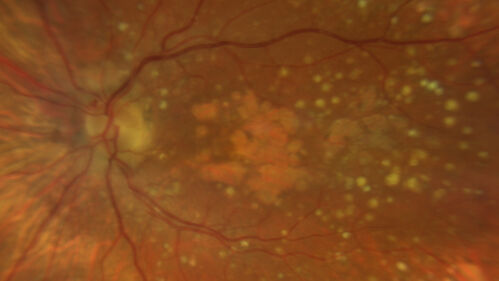 Age-related macular degeneration - Geographic Atrophy - Intermittent CME left eye from CRVO, Anemia, Diabetes
79 year old female - 3 years post CRVO in the left eye (20/32 VA) with intermittent CME.  Left eye is the better eye.  Vision is stable since 2 years ago
PMHx: Type II DM x 20 years, Chronic Anemia, Hyperlipidemia
VA 20/200 OD, 20/50 OS (usually 20/40)
