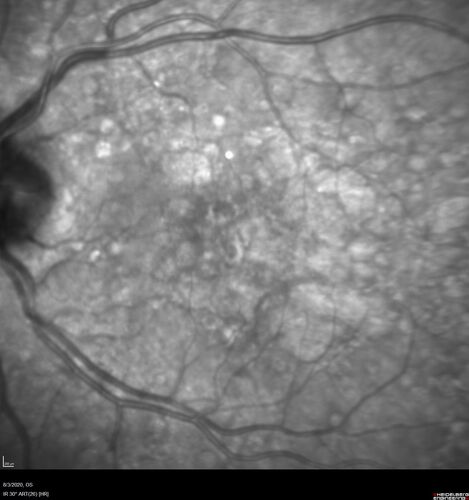 Age-related macular degeneration - Geographic Atrophy - Intermittent CME left eye from CRVO, Anemia, Diabetes
79 year old female - 3 years post CRVO in the left eye (20/32 VA) with intermittent CME.  Left eye is the better eye.  Vision is stable since 2 years ago
PMHx: Type II DM x 20 years, Chronic Anemia, Hyperlipidemia
VA 20/200 OD, 20/50 OS (usually 20/40)
