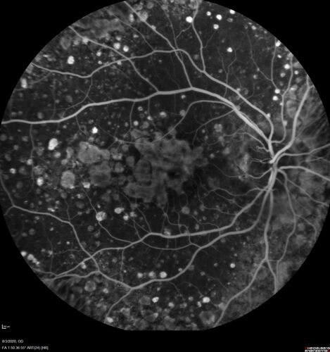 Age-related macular degeneration - Geographic Atrophy - Intermittent CME left eye from CRVO, Anemia, Diabetes
79 year old female - 3 years post CRVO in the left eye (20/32 VA) with intermittent CME.  Left eye is the better eye.  Vision is stable since 2 years ago
PMHx: Type II DM x 20 years, Chronic Anemia, Hyperlipidemia
VA 20/200 OD, 20/50 OS (usually 20/40)
