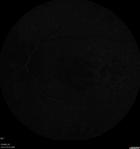 Dry AMD geographic atrophy and cystoid macular edema
79 year old vision is in for a checkup with no visual complaints in the left eye.  This is her better eye.  VA 20/200 OD, 20/50 OS.  3 years ago she had a CRVO in the left eye.  She is also diabetic for 20 years, has carotid insufficiency and anemia.  Left eye shows CME.  This was not treated and the vision improved to 20/40 over the next year although mild edema persisted.
