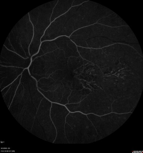 Age-related macular degeneration - Geographic Atrophy - Intermittent CME left eye from CRVO, Anemia, Diabetes
79 year old female - 3 years post CRVO in the left eye (20/32 VA) with intermittent CME.  Left eye is the better eye.  Vision is stable since 2 years ago
PMHx: Type II DM x 20 years, Chronic Anemia, Hyperlipidemia
VA 20/200 OD, 20/50 OS (usually 20/40)
