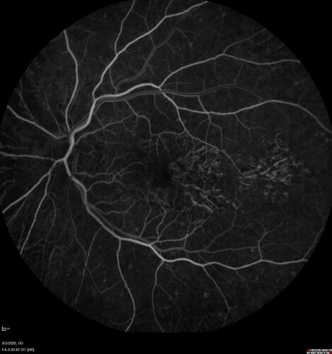 Age-related macular degeneration - Geographic Atrophy - Intermittent CME left eye from CRVO, Anemia, Diabetes
79 year old female - 3 years post CRVO in the left eye (20/32 VA) with intermittent CME.  Left eye is the better eye.  Vision is stable since 2 years ago
PMHx: Type II DM x 20 years, Chronic Anemia, Hyperlipidemia
VA 20/200 OD, 20/50 OS (usually 20/40)

