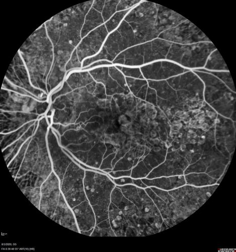 Age-related macular degeneration - Geographic Atrophy - Intermittent CME left eye from CRVO, Anemia, Diabetes
79 year old female - 3 years post CRVO in the left eye (20/32 VA) with intermittent CME.  Left eye is the better eye.  Vision is stable since 2 years ago
PMHx: Type II DM x 20 years, Chronic Anemia, Hyperlipidemia
VA 20/200 OD, 20/50 OS (usually 20/40)
