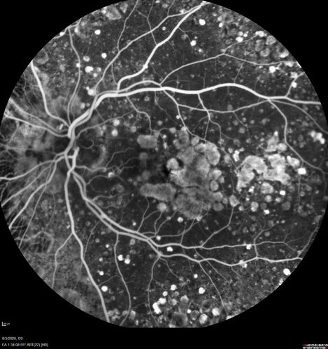 Age-related macular degeneration - Geographic Atrophy - Intermittent CME left eye from CRVO, Anemia, Diabetes
79 year old female - 3 years post CRVO in the left eye (20/32 VA) with intermittent CME.  Left eye is the better eye.  Vision is stable since 2 years ago
PMHx: Type II DM x 20 years, Chronic Anemia, Hyperlipidemia
VA 20/200 OD, 20/50 OS (usually 20/40)
